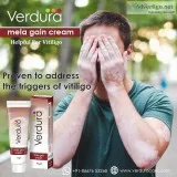 Cream For Vitiligo