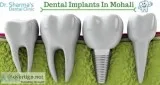Best Dental Implant In Mohali