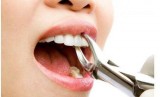 Tooth Fillings Arlington VA