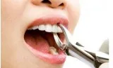 Tooth Fillings Arlington VA