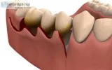 Best PERIO FLAPS and GRAFTS Course In Hyderabad