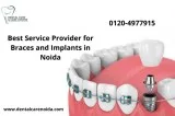 Best Service Provider for Braces and Implants in Noida
