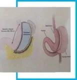 Laparoscopic obesity/ bariatric/ weight loss surgery & treatment