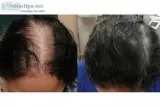 Help for Hair Loss &ndash an Effective Hair Loss Solution