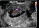 Sonohysterography
