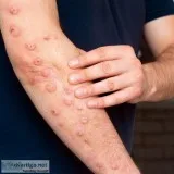 Are you suffering from chronic severe itch with bumps on the ski
