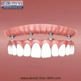 Single Tooth Implant Cost in Delhi