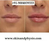 TREATMENT FOR LIP AUGMENTATION