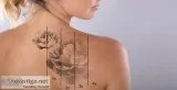 Tattoo Removal in Delhi