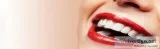 Teeth Whitening Singapore - Mirage Aesthetic