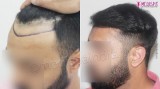Avail Best Hair Transplant Surgery by Dr. Suneet Soni