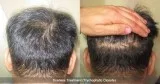 Important Factors of Hair Transplant to get the best treatment