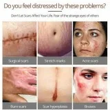 Berkowits Acne Scar and Stretch Marks Removal Treatment