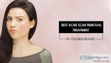 Acne scar removal treatment in Hyderabad