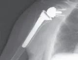 BEST JOINT REPLACEMENT SURGEON IN AHMEDABAD  Dr Tejas Gandhi
