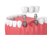 Implant dentist in chennai - akeela dental care