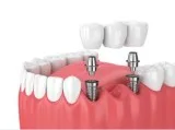 Implant dentist in chennai - akeela dental care