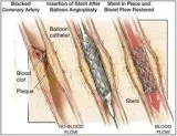 What is a better option for angioplasty A bare metal stent or a 
