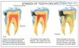 Root canal treatment cost in Gurgaon