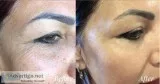 Blue scorpion venom skincare