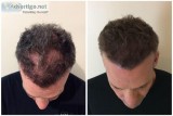 SMUK Offer Scalp Micropigmentation Treatment