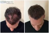 SMUK Offer Scalp Micropigmentation Treatment