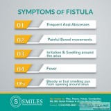Complex fistula treatment in bangalore - smiles