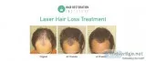 Laser Hair Loss Treatment in Minnesota