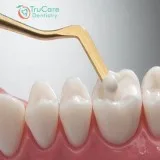 Tooth Colored Bonding In Roswell Georgia