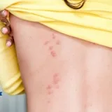 Bed Bug Treatments in Michigan