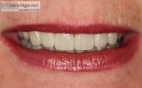Porcelain Veneers Mississauga ON  Fieldgate Dental