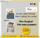 Hair Patch in Delhi