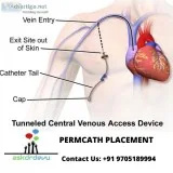 Ask dr devu aovarian vein syndrome symptoms bronchial artery emb
