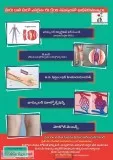 Ask dr devu aovarian vein syndrome symptoms bronchial artery emb