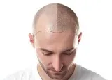 Hair Transplant in Hyderabad  Best Hair Transplant Clinic in Hyd