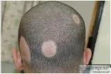 Best alopecia areata treatment clinic in delhi