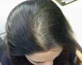 Telogen effluvium treatment delhi - satya skin & hair clinic