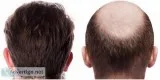 Fue treatment in kamla nagar - satya hair clinic