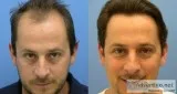Follicular unit transplant - fut treatment in delhi