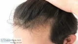 Follicular unit transplant - fut treatment in delhi