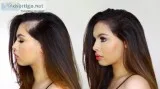 Post partum hair loss treatment delhi - satya skin & hair clinic