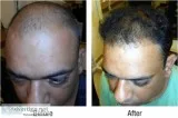 Hair loss treatments for men- satya skin & hair clinic