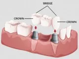 Bridge & crown treatment