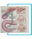 Hernia surgery procedure & repair- inguinal hernia surgery
