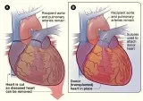 Cardiothoracic Surgeon Sacramento