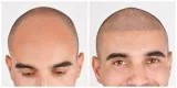 Scalp pigmentation