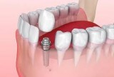 Tooth Implant Cost in India  City Dental Centre