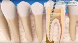 Rotary Endodontics Course  and Endodontics Course India in Affor