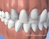 Flipper Tooth Near Me  Columbiascperiodonti st.com