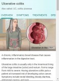 Ulcerative Colitis (UC) Paid Clinical Trial